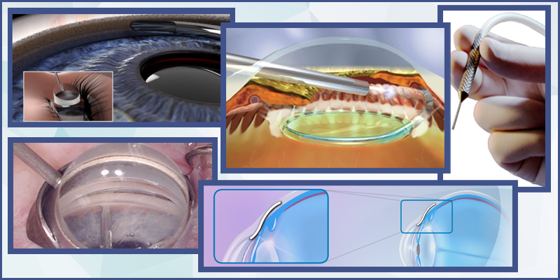 Minimally Invasive Glaucoma Surgery Costello Eye