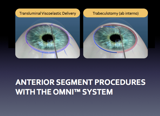 anterior segment procedures with the omni system
